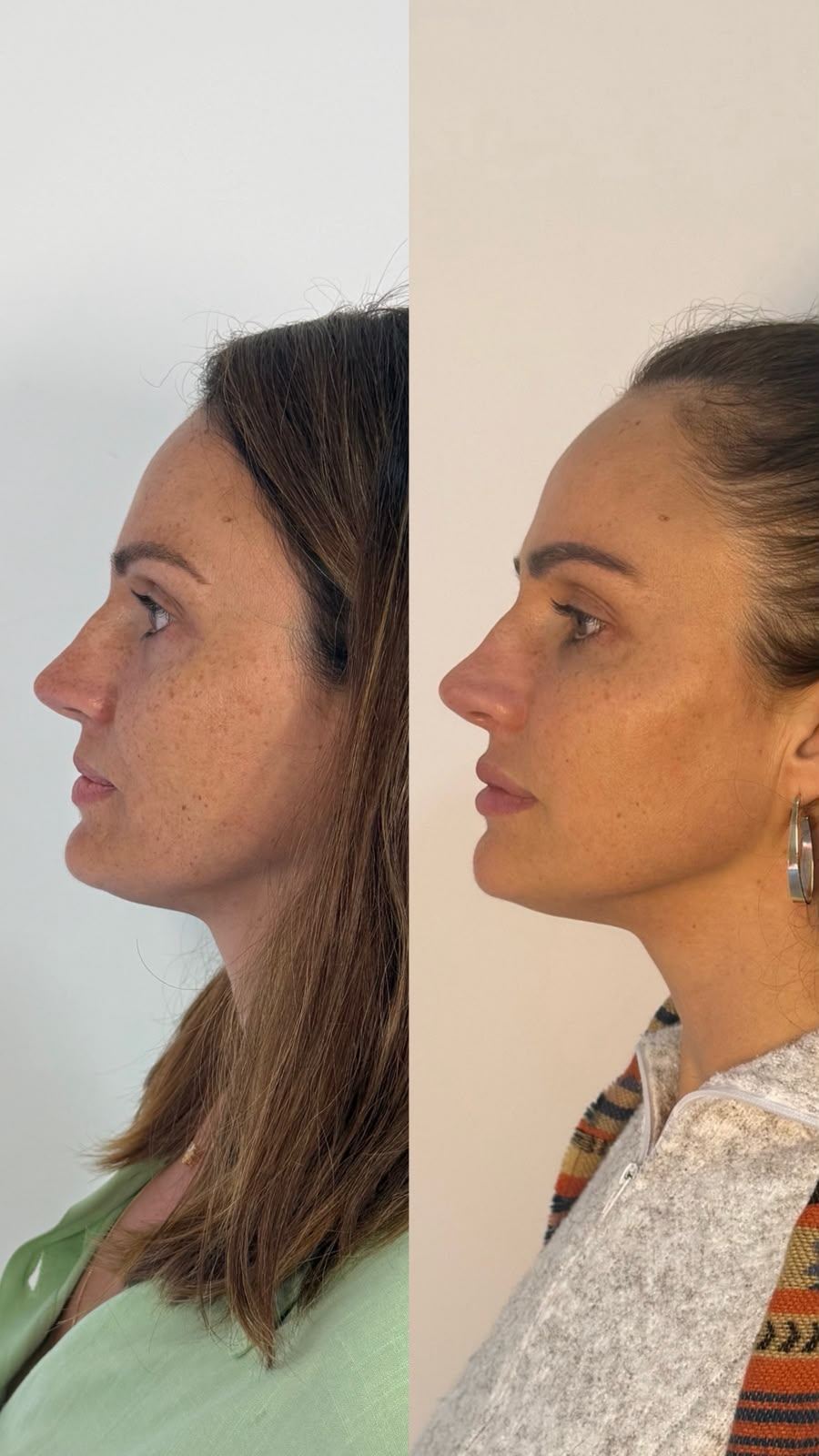 Antes e depois — caso 3