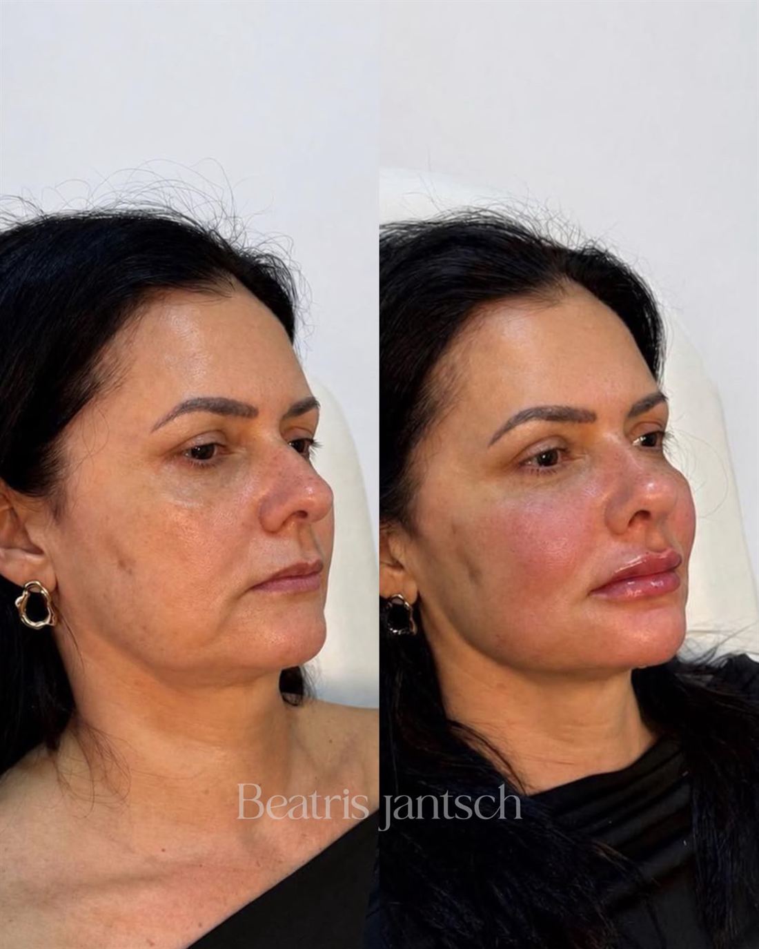 Antes e depois — caso 10