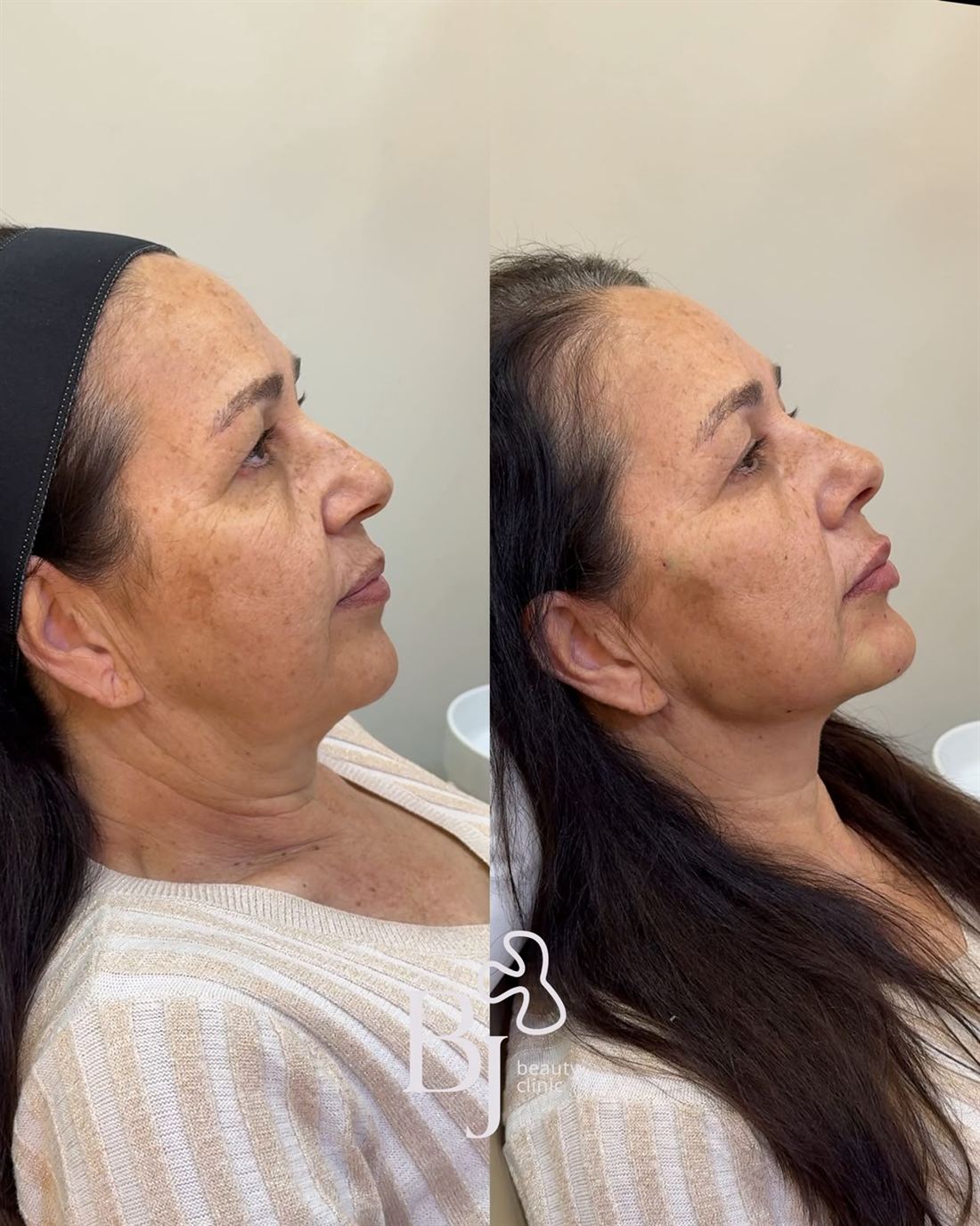 Antes e depois — caso 11