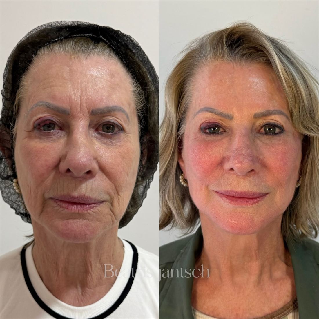 Antes e depois — caso 12
